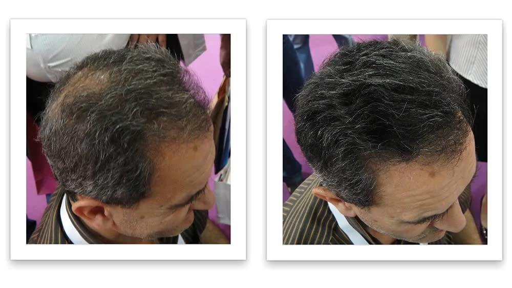 Caboki Hair Loss Concealer (All-Natural Hair Building Fibers) Travel Size. (Salt & Pepper - Dark)
