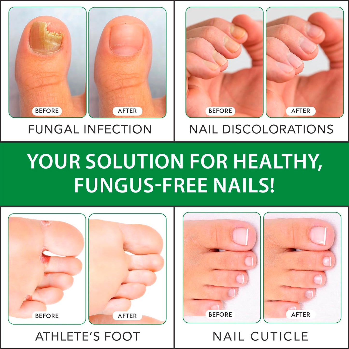 Viking Revolution Toenail Fungus Treatment Extra Strength with 1% Tolnaftate OTC - Nail Fungus Treatment for Toenail Tea Tree Oil Fungus Nail Treatment - Athletes Foot Toe Fungus Treatment Oregano Oil