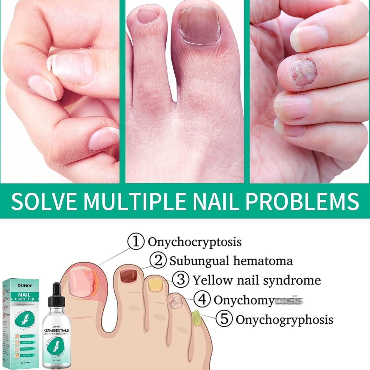 MUBSEOTH Kerassentials Toenail Oil, Kerassentials Nails Nutrient Oil, Nail Repair Solution 30ML/1PCS (4PCS)
