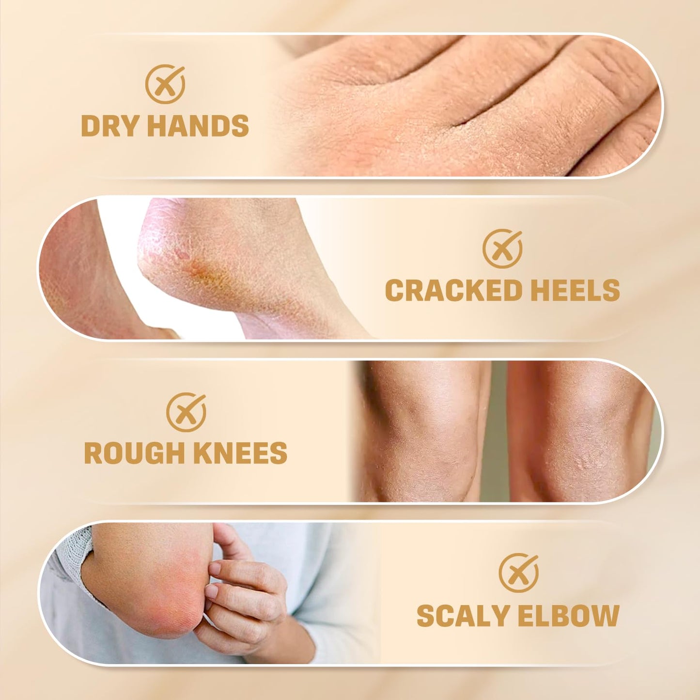 60% Urea Cream with 2% Salicylic Acid, Urea Cream 60 Percent For Feet Maximum Strength, Urea Lotion For Feet and Hand for Rough, Dry, Thick & Cracked Skin, Deep Moisturizing and Callus Removing-150g