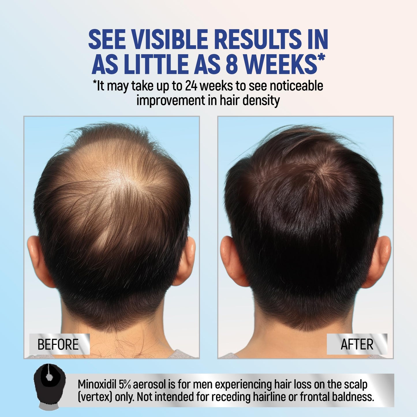 Taro Minoxidil Topical Aerosol Foam, 5%, Hair Regrowth 2 Months Treatment for Men, 2.11 oz (2 Pack)