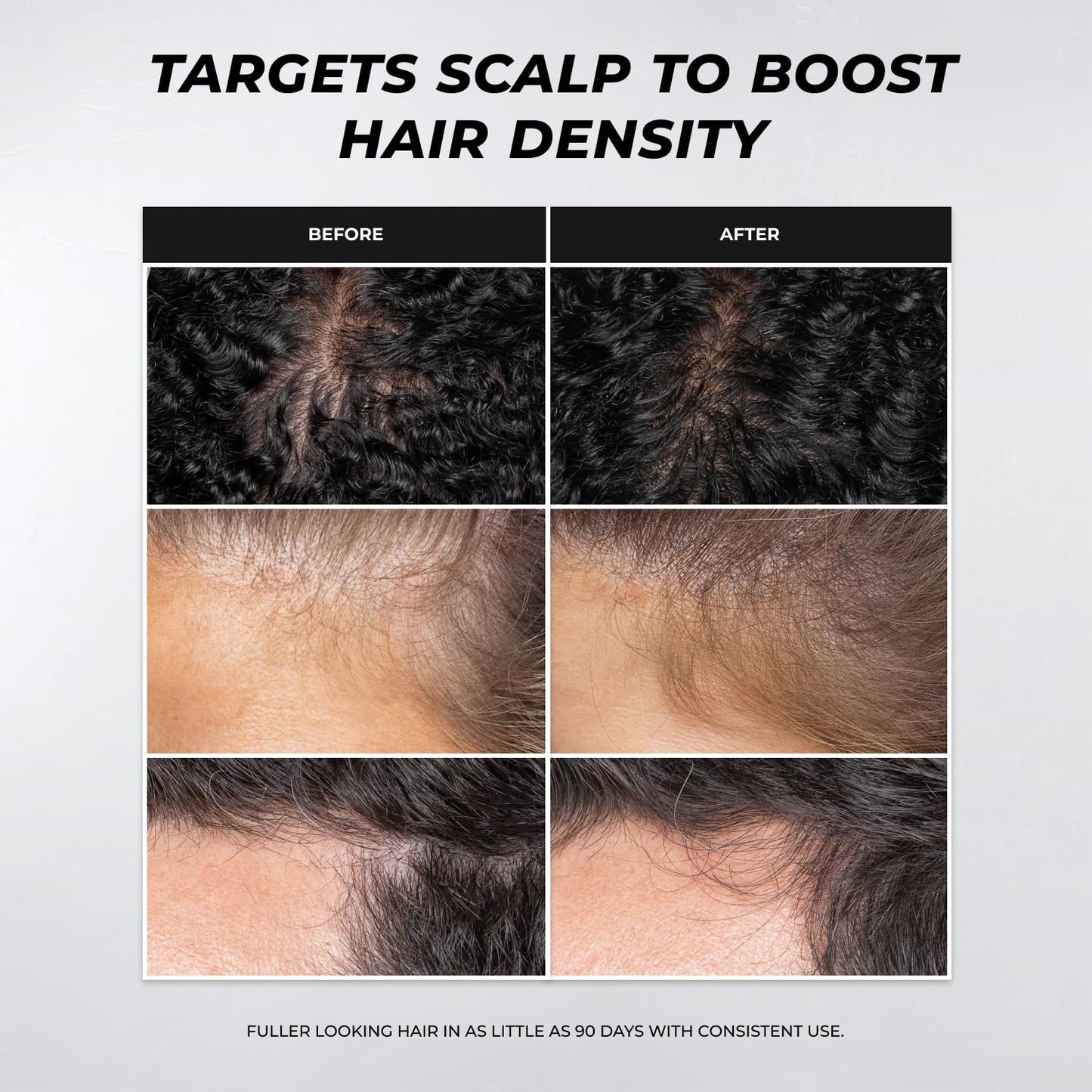 XMONDO Hair A3 Complex Scalp Foam for Hair Density | Vegan Formula with Biollagen & Amaranth, Fast-Acting Plant Actives For Amplified Volume & Visibly Fuller, Healthier-Looking Hair, 3.38 Fl Oz