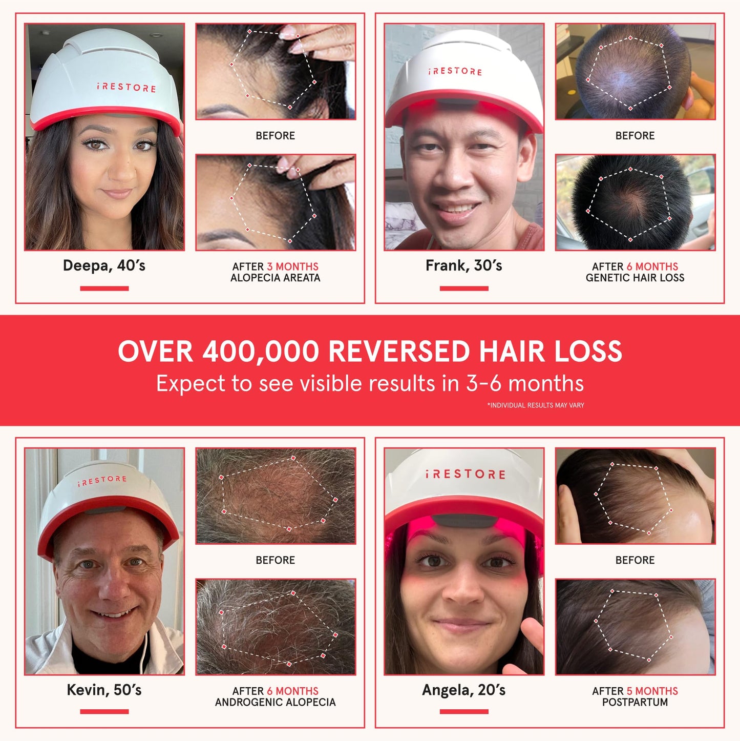 iRestore Skincare & Hair Care Power Duo – LED Therapy for Radiant Skin & Laser Hair Growth System