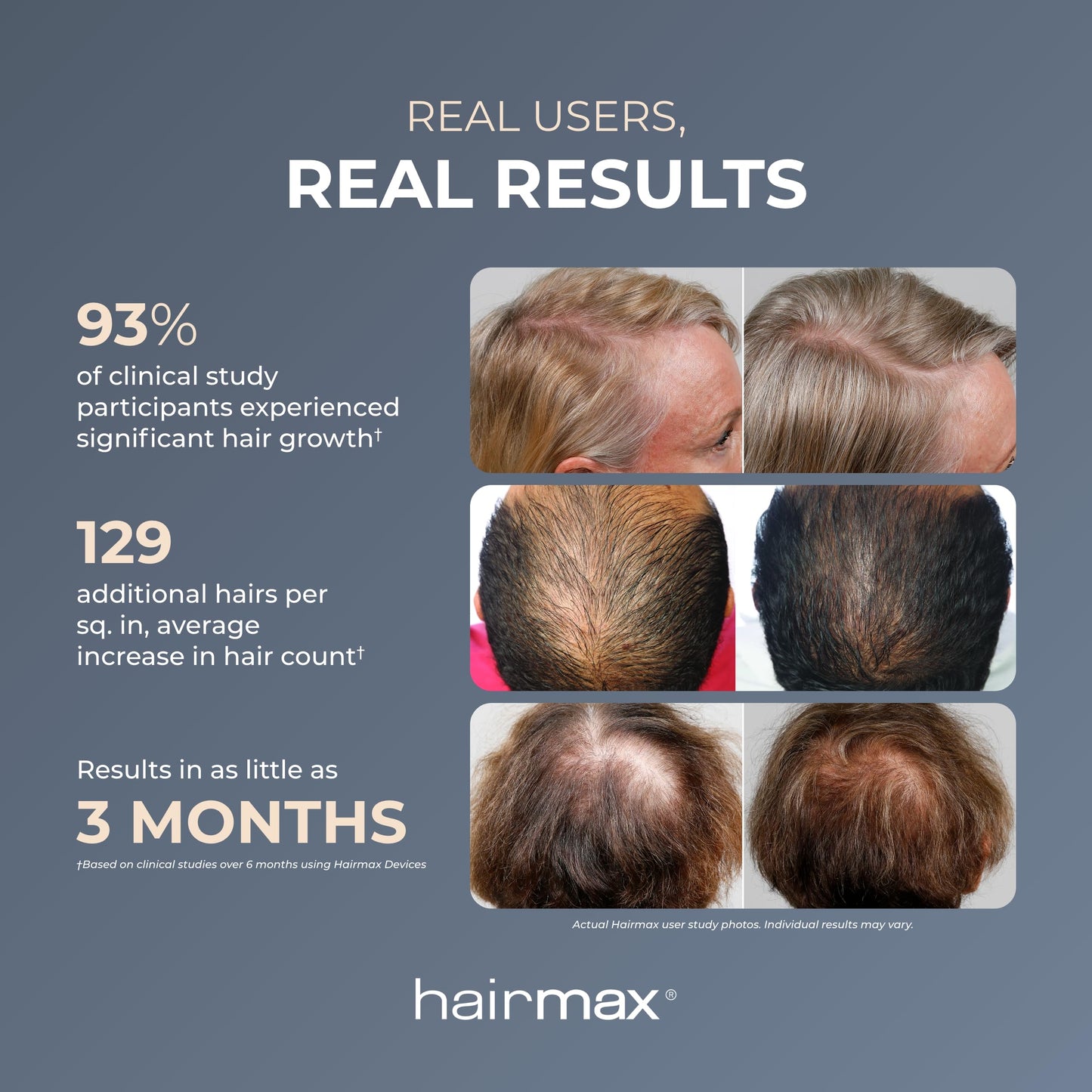 Hairmax Ultima 12 LaserComb - (FDA Cleared) Laser Hair Regrowth Treatment Device for Men & Women - Reverses Thinning Hair Loss - Red Light Therapy to Stimulate Hair Growth - Cordless Design