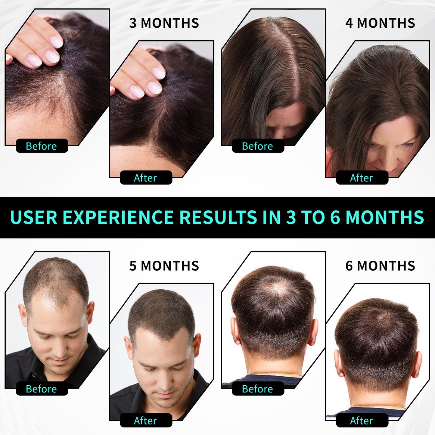 Laser Cap Wireless Laser Therapy Device for Hair Regrowth in Men & Women with Androgenic Alopecia